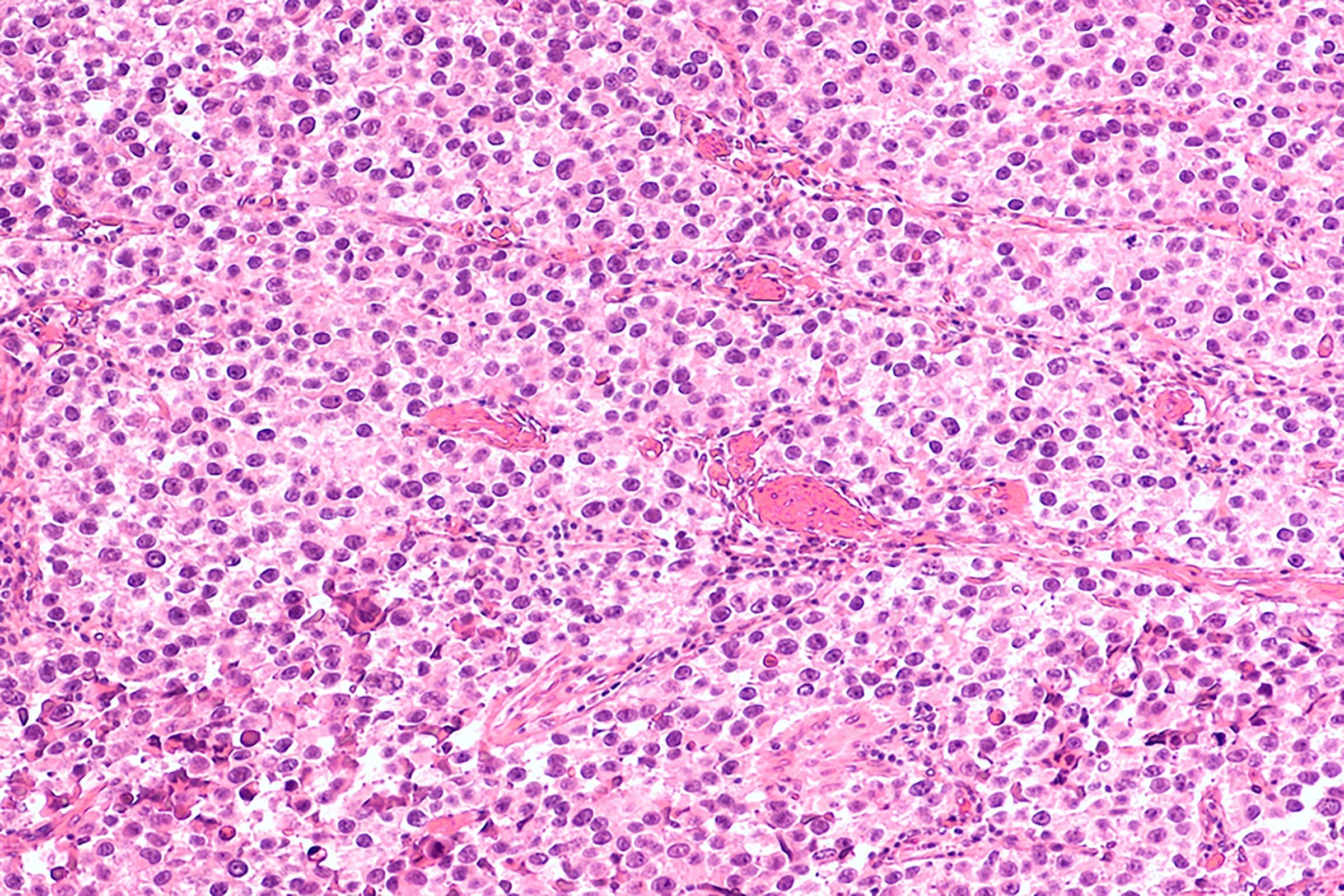 testicularcancer