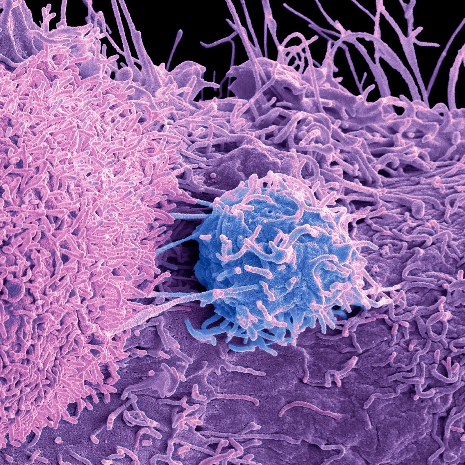 Prostate Cancer cells