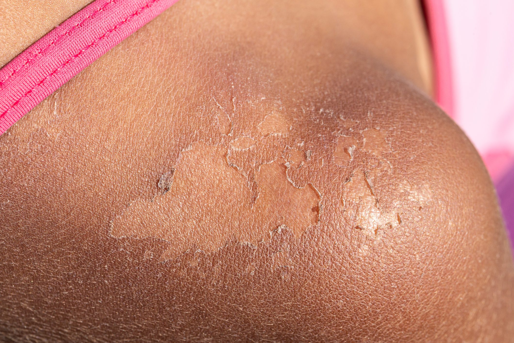 11 Signs Your Sunburn Is Actually Sun Poisoning, According to Expert Dermatologists